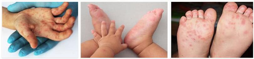 Meaning of Hand Foot Mouth Disease in English
